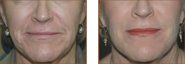 Dermal Fillers Boise Image Enhancement Centre