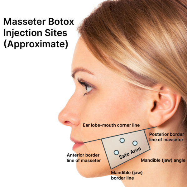 Masseter Botox Botox for TMJ, Botox for Migraines, Info, Cost