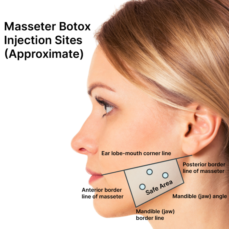 Masseter Botox Botox For Tmj Botox For Migraines Info Cost