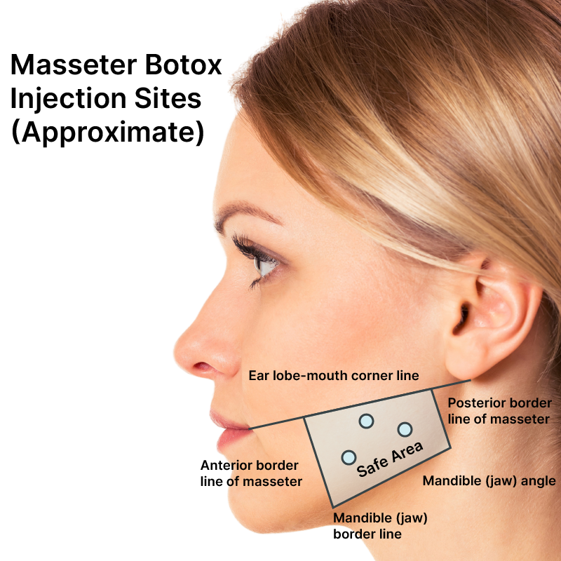 Masseter botox botox for tmj botox for migraines info cost
