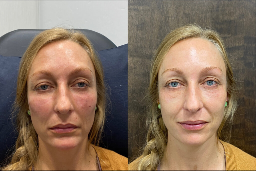 The Botox Brow Lift Guide: Botox Eyebrow Lift Before & Afters, Info