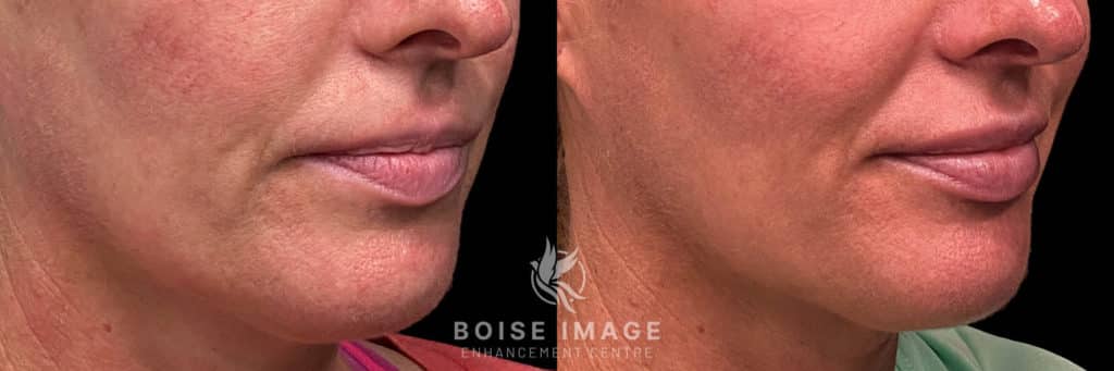 Volbella Lip Filler Before and After 1