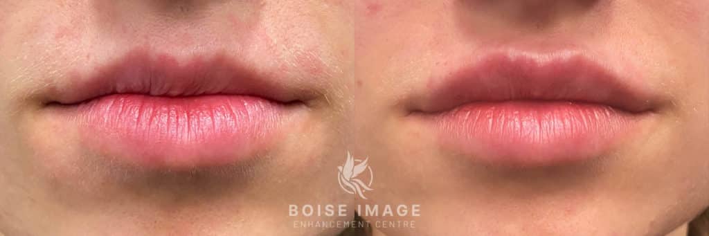 Restylane Silk Lip Filler Before and After Photo
