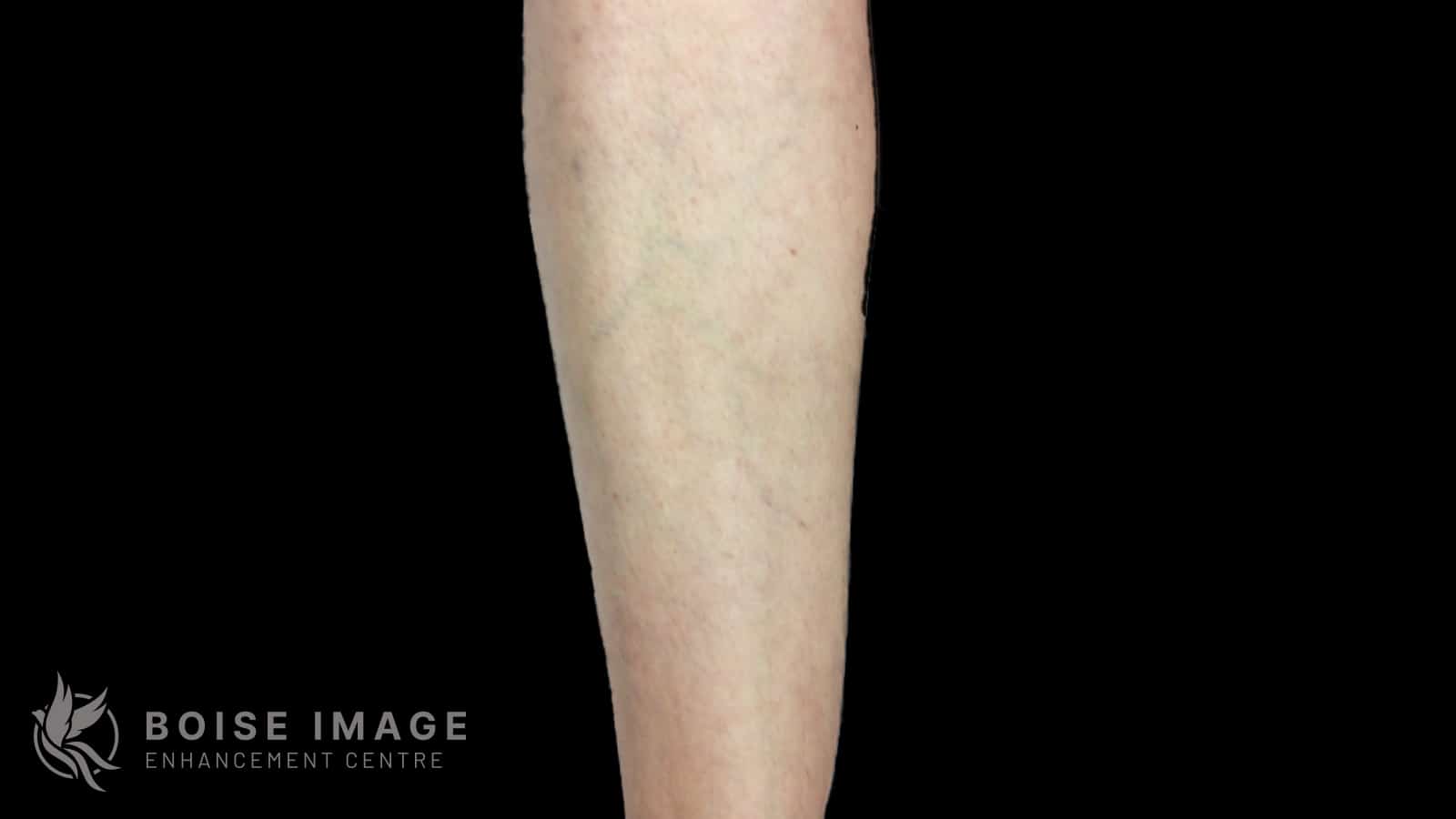 Anterior Thigh After