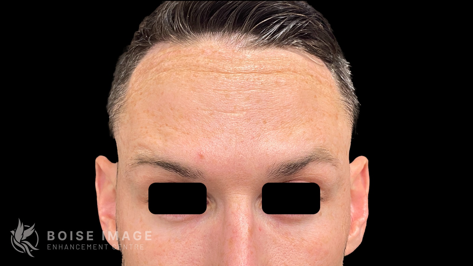 Forehead After