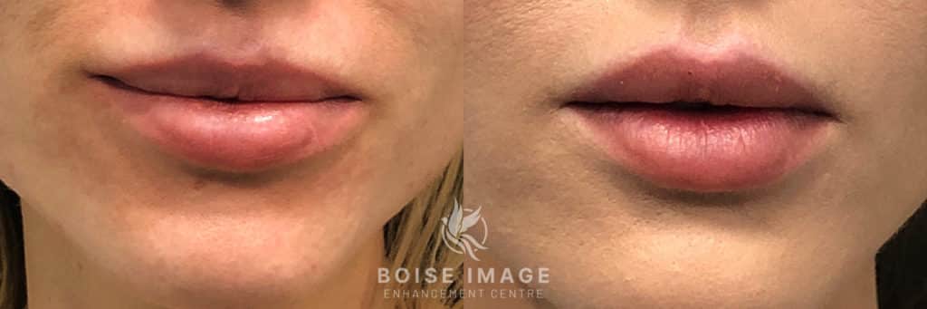 Lip Filler Reset Refill Before and After
