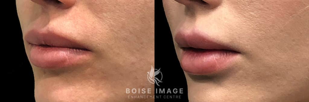 Lip Filler Reset Refill Before and After Profile