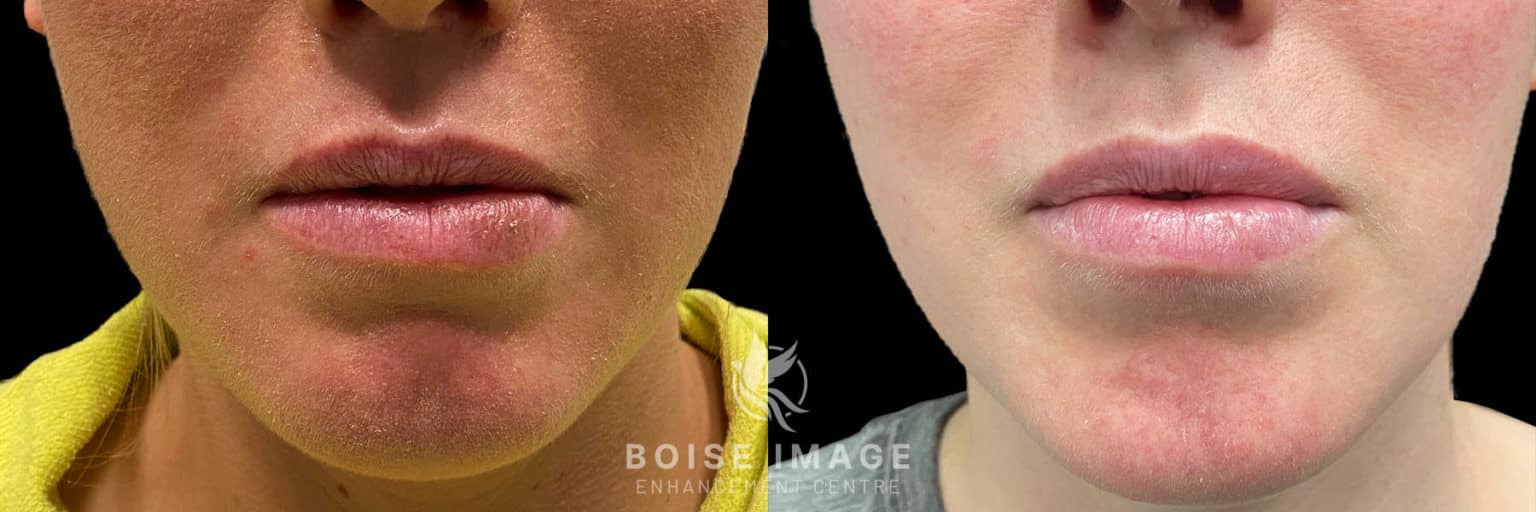 Dissolving Lip Filler Blog Boise Image Enhancement Centre