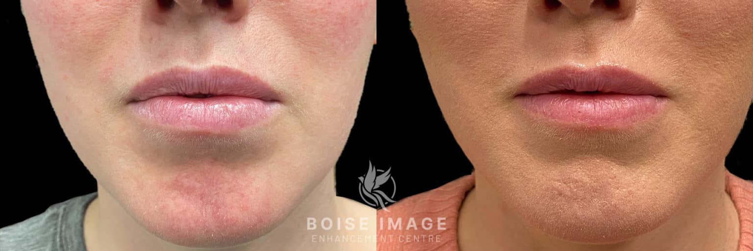 Dissolving Lip Filler Blog Boise Image Enhancement Centre