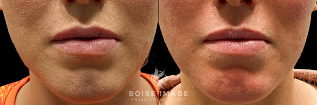 Lip Filler Dissolving Before and After - Treatment 2