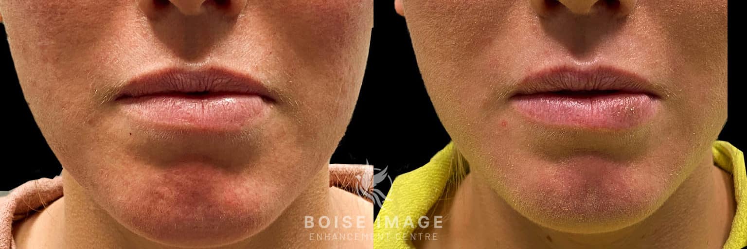 Dissolving Lip Filler Blog Boise Image Enhancement Centre
