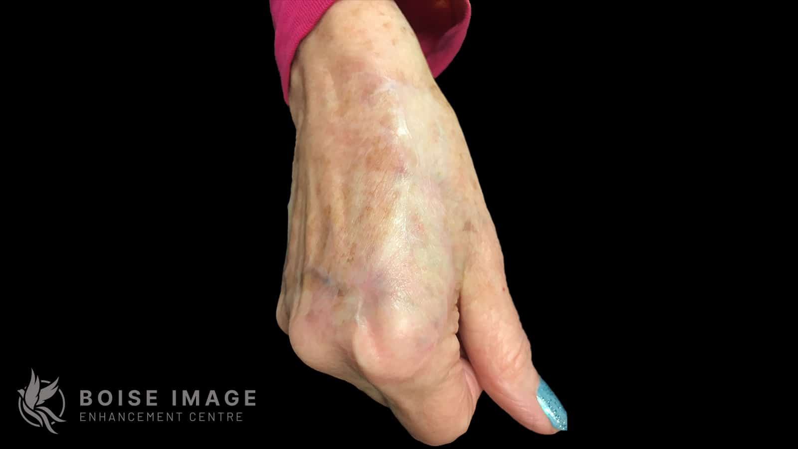 Scar Reduction Hand After