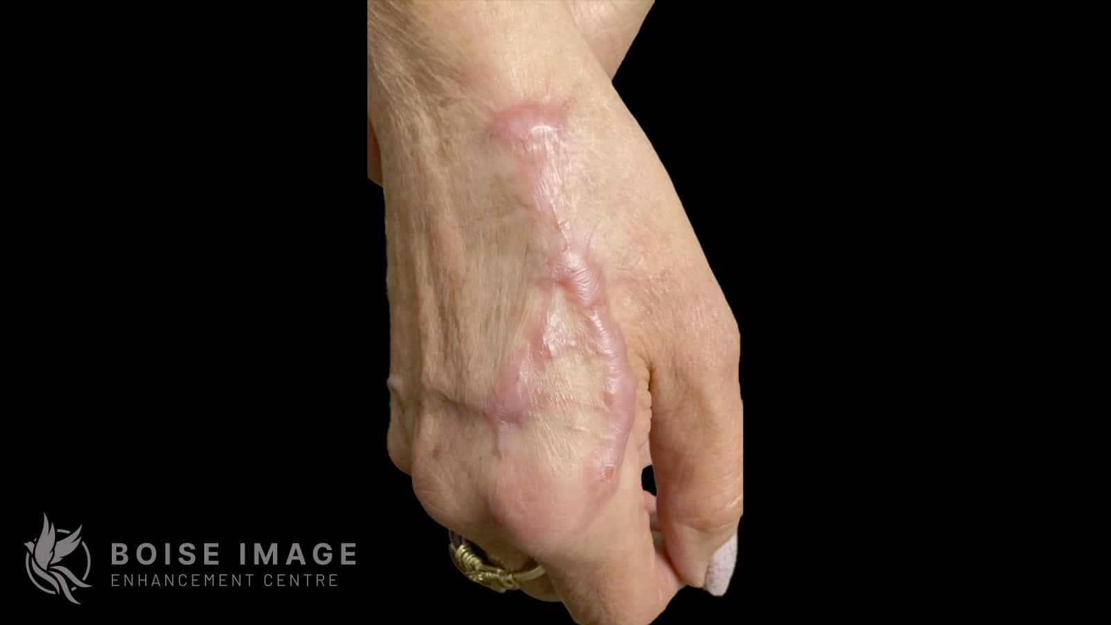 Scar Reduction Hand Before